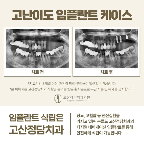 의정부임플란트치과, 비용 비교 전에 함께 확인해야 할 5가지