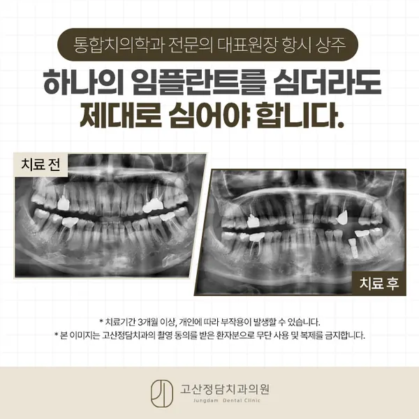 민락동임플란트, 치과 선택할 때 수술 경험을 확인해야 하는 이유