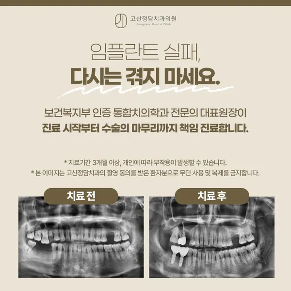 의정부임플란트재수술 흔들리거나 잇몸이 붓는다면 다시 심어야 할까요?
