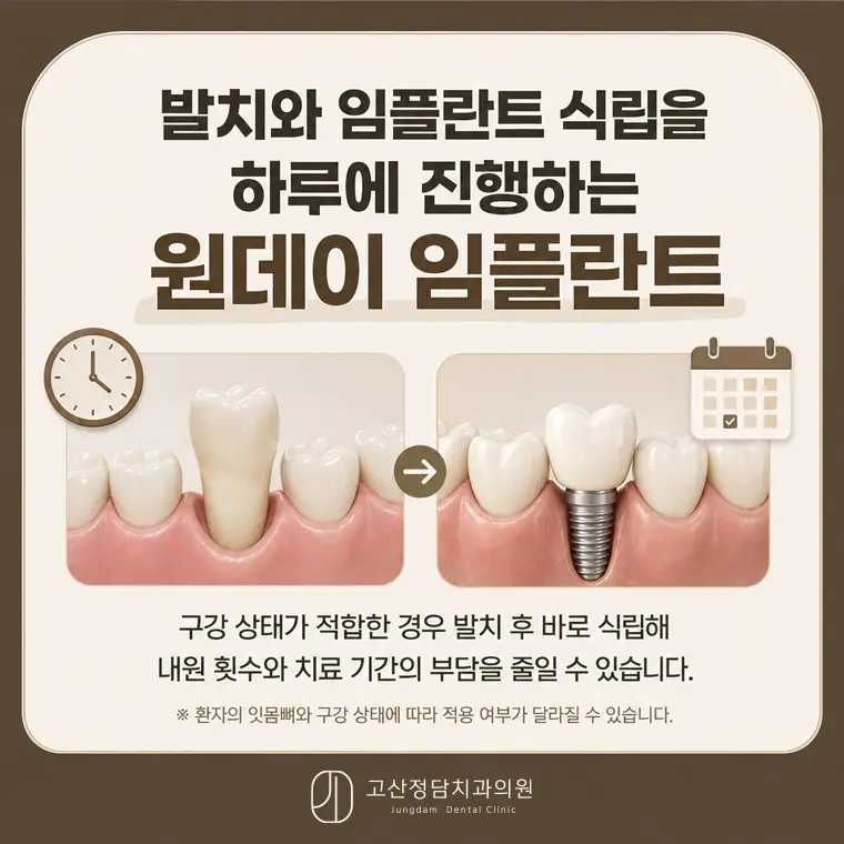 의정부치과 고산정담치과의원이 전하는 임플란트 치료 정보입니다.