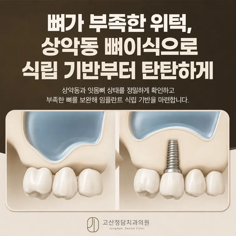 의정부치과 고산정담치과의원이 안내하는 네비게이션 임플란트 정보입니다.