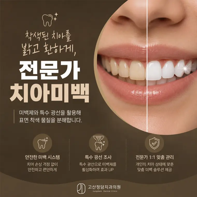 고산동치과 고산정담치과의원에서 소개하는 치아미백 가이드