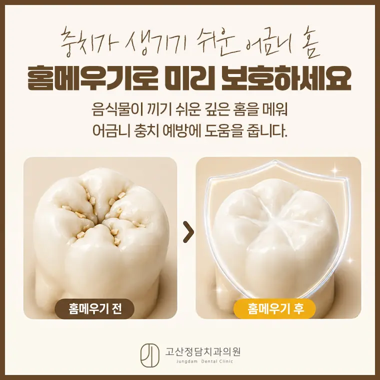 의정부치과 충치치료·잇몸치료 자연치아 보존 안내 | 고산정담치과