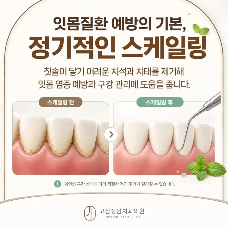 고산정담치과의원은 자연치아를 최대한 보존하는 치료를 우선적인 가치로 두고, 필요한 경우에만 치료를 안내하고 있습니다.