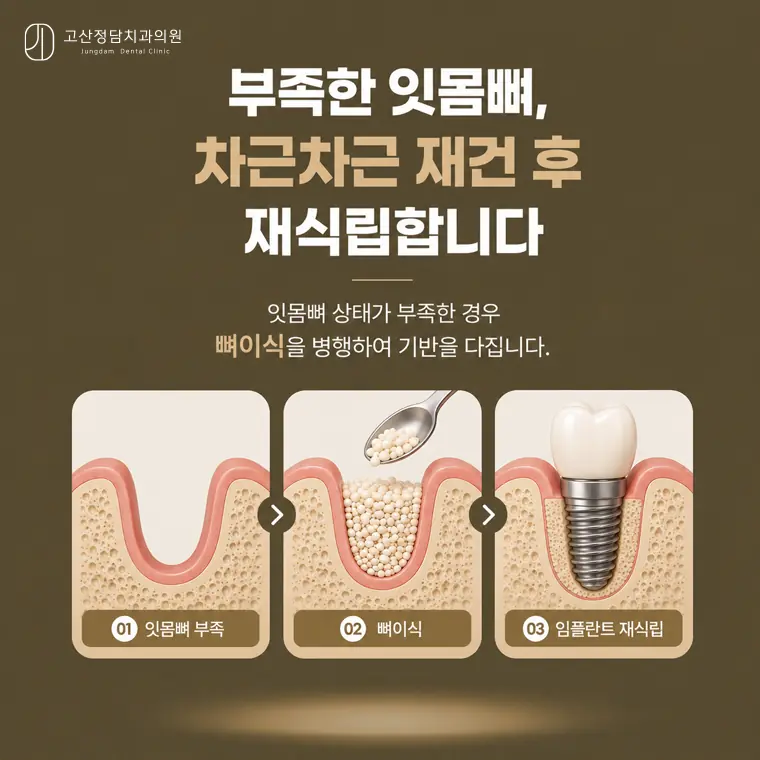고산동치과 고산정담치과의원에서 전해드리는 임플란트 정보