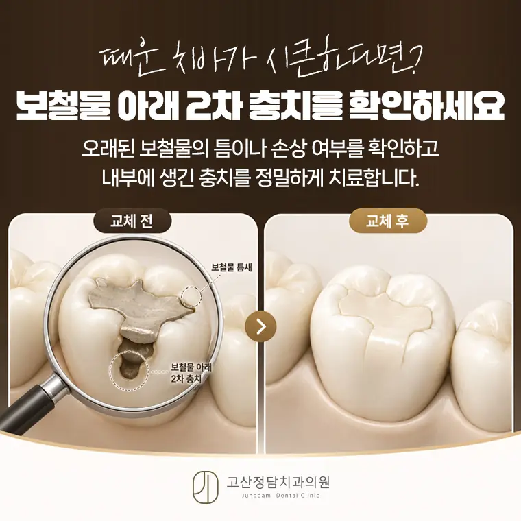 의정부치과, 고산동치과, 의정부충치치료, 의정부잇몸치료, 치과보존과, 스케일링